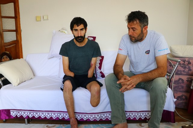 Elektrik Akımına Kapılıp Kollarını ve Bacağını Kaybeden Hasta Kol Nakli Bekliyor