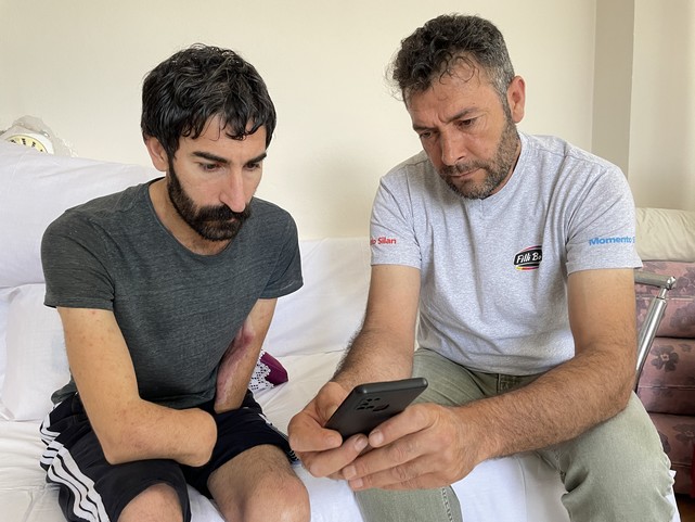 Elektrik Akımına Kapılıp Kollarını ve Bacağını Kaybeden Hasta Kol Nakli Bekliyor