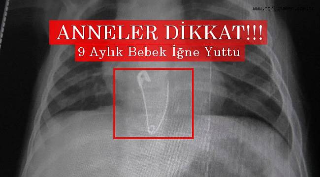 9 Aylık Bebek İğne Yuttu