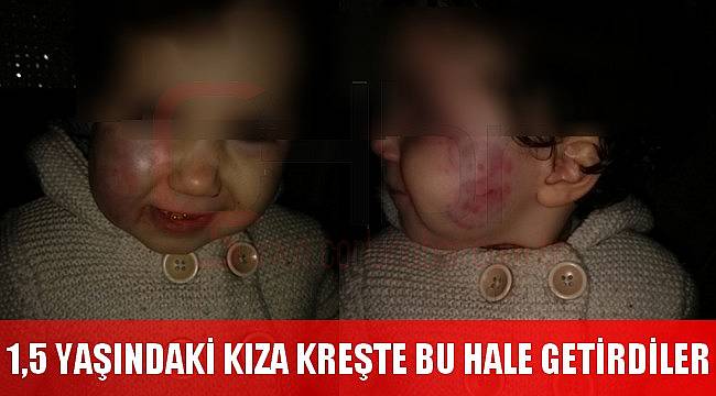 1.5 Yaşındaki Kızı Kreşte Bu Hale Getirdiler