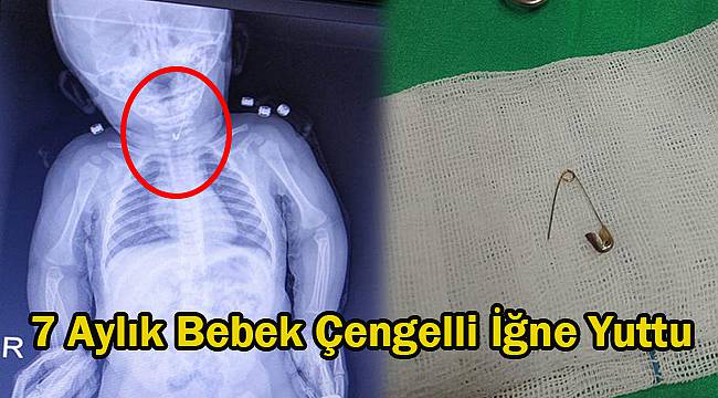 7 Aylık Bebek Çengelli İğne Yuttu