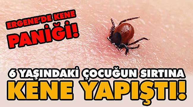 Ergene'de 6 Yaşındaki Çocuğun Sırtına Kene Yapıştı