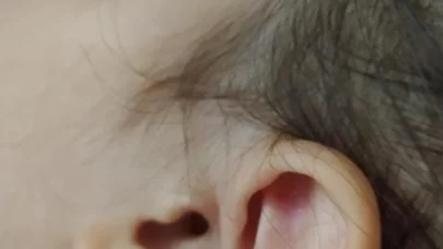 İzmit’te parkta 3 yaşındaki çocuğun kulağına kene yapıştı