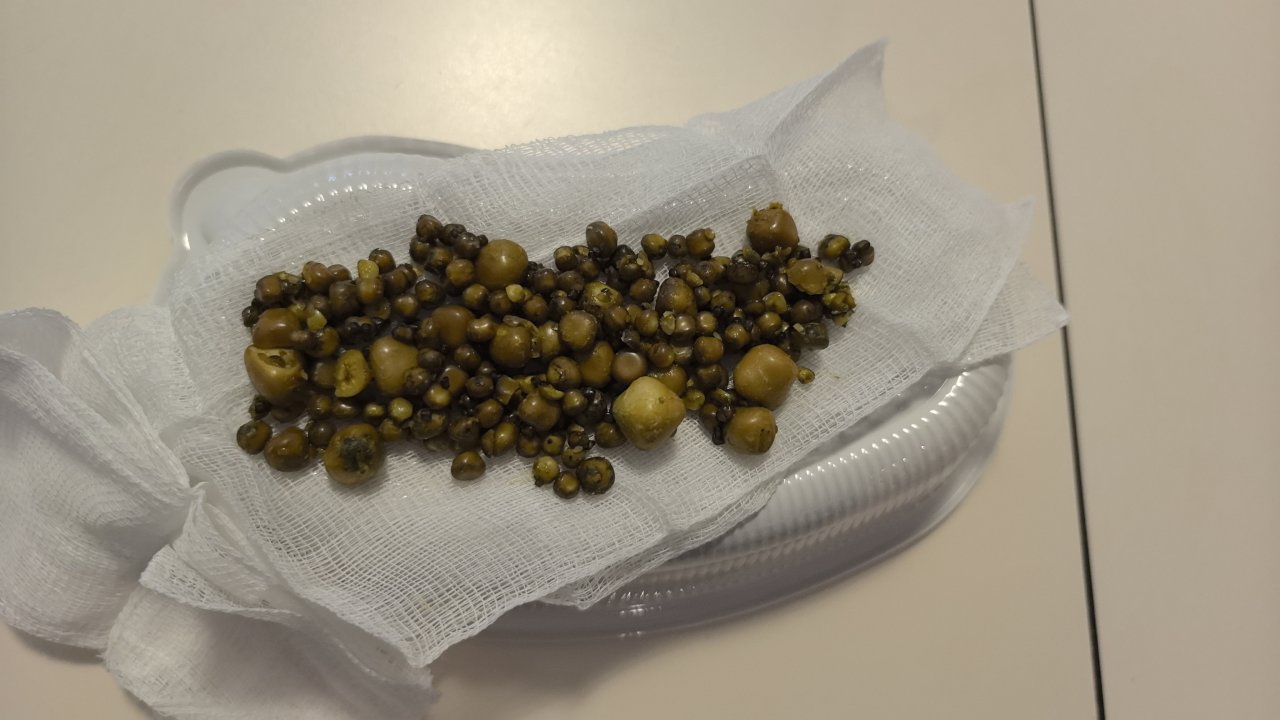 Bursa&#039;da 77 yaşındaki kadının safra kesesinden 213 tane taş çıkarıldı