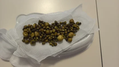 Bursa'da 77 yaşındaki kadının safra kesesinden 213 tane taş çıkarıldı