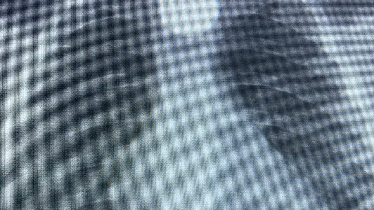 3 yaşındaki Bilal'in, yuttuğu 50 kuruş yemek borusunda takıldı