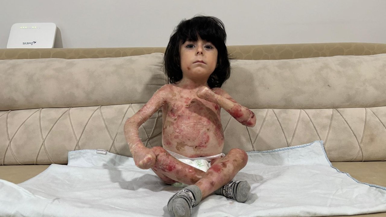 4 yaşındaki İbrahim, 'Kelebek hastalığı' nedeniyle kıyafet giyemiyor