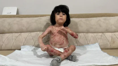 4 yaşındaki İbrahim, 'Kelebek hastalığı' nedeniyle kıyafet giyemiyor